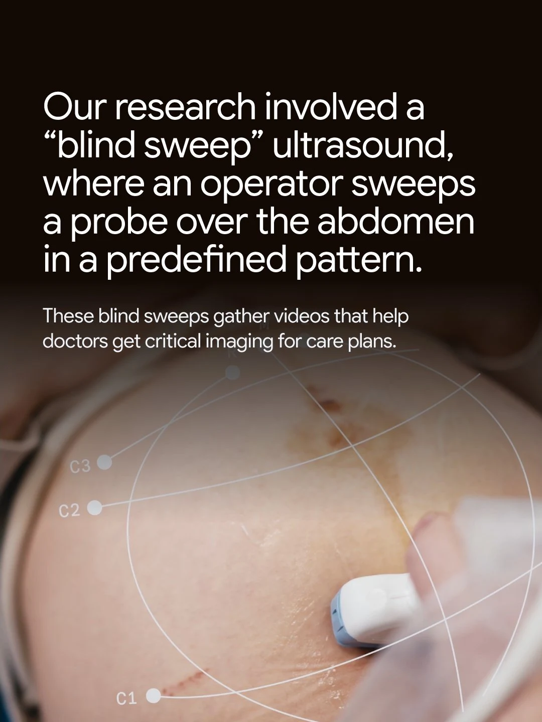 An operator holds an ultrasound probe over an abdomen overlaid with sweep pattern lines accompanied by text describing a "blind sweep" ultrasound research project and how it works.